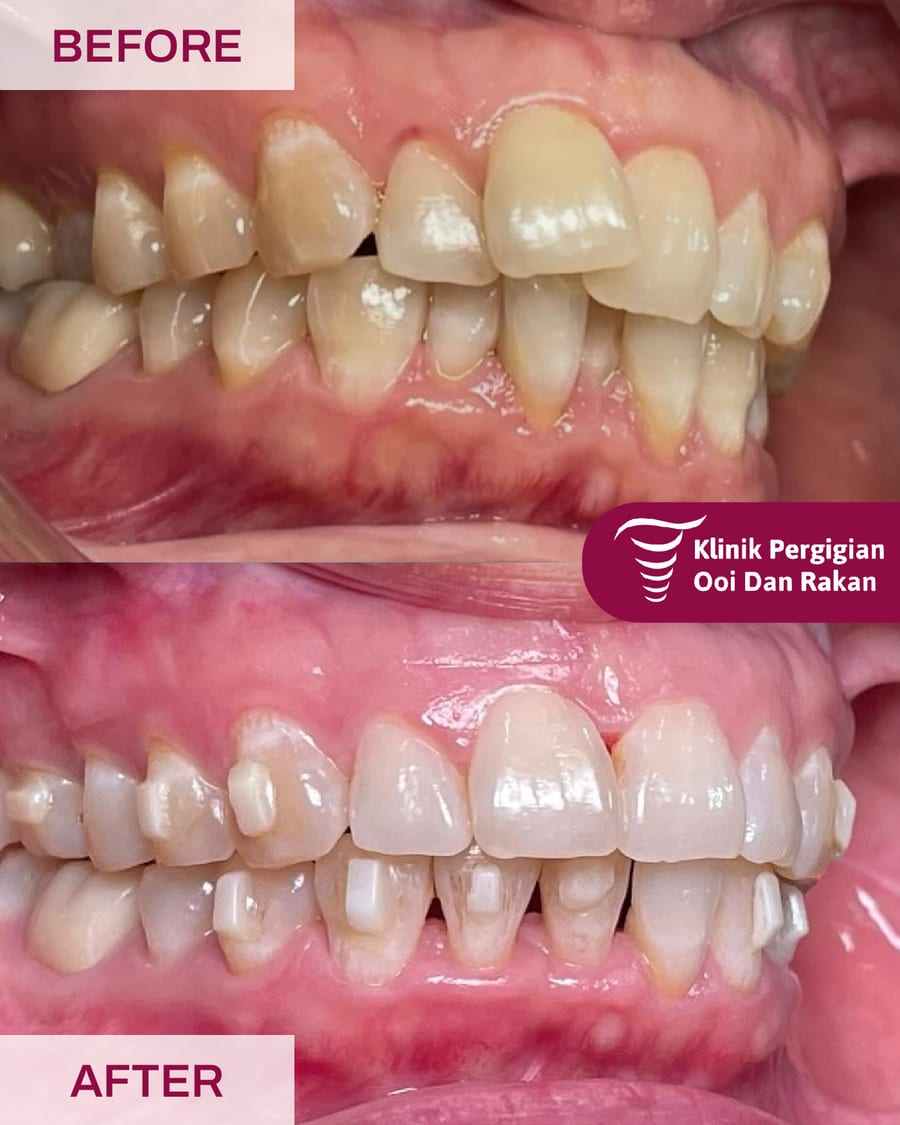 Before and after braces treatment at Ooi Dan Rakan, case 2