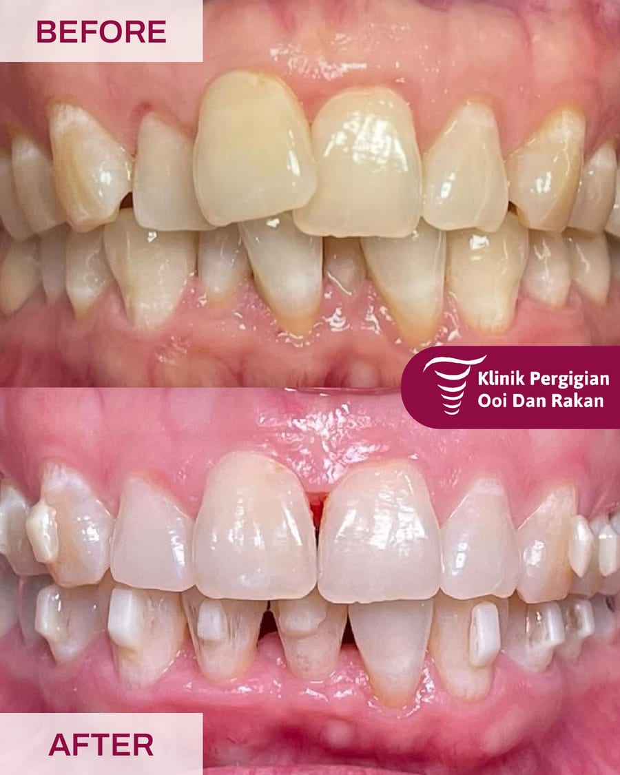 Before and after braces treatment at Ooi Dan Rakan, case 3