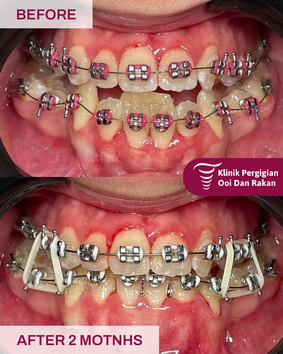 Before and after braces treatment at Ooi Dan Rakan, case 6