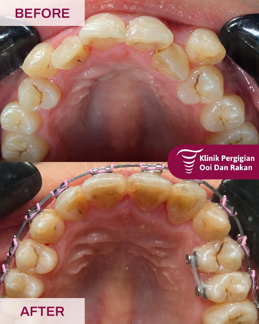 Before and after braces treatment at Ooi Dan Rakan, case 7