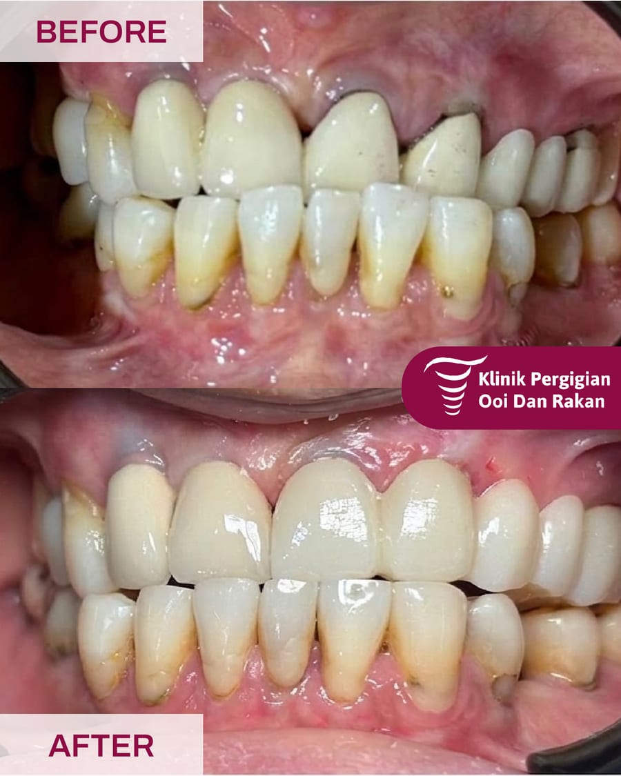Before and after crowns and bridges treatment at Ooi Dan Rakan, case 1