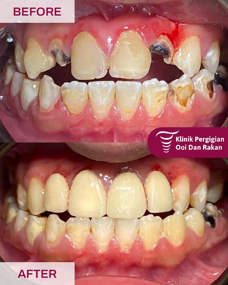 Before and after crowns and bridges treatment at Ooi Dan Rakan, case 4