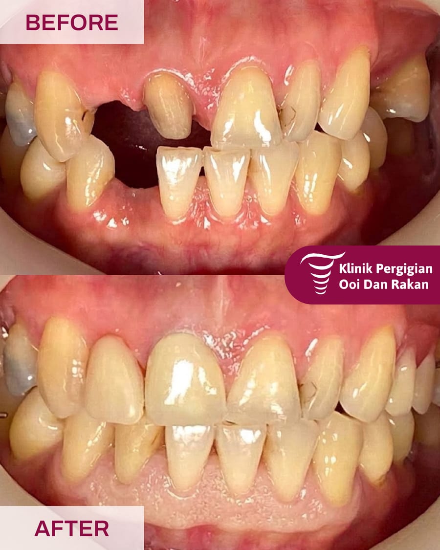 Before and after crowns and bridges treatment at Ooi Dan Rakan, case 5