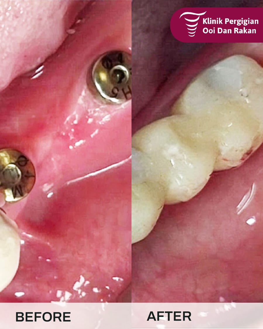 Before and after crowns and bridges treatment at Ooi Dan Rakan, case 7