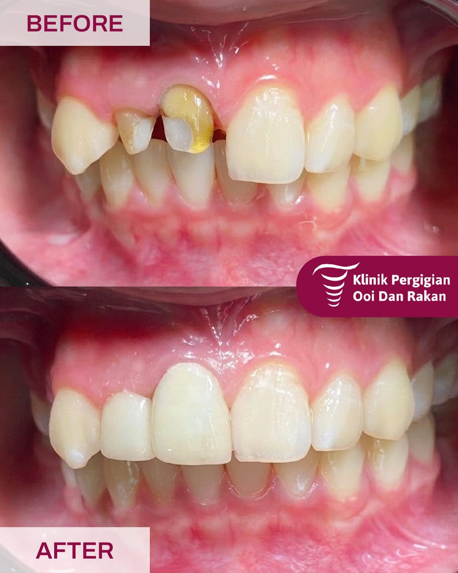 Before and after crowns and bridges treatment at Ooi Dan Rakan, case 8