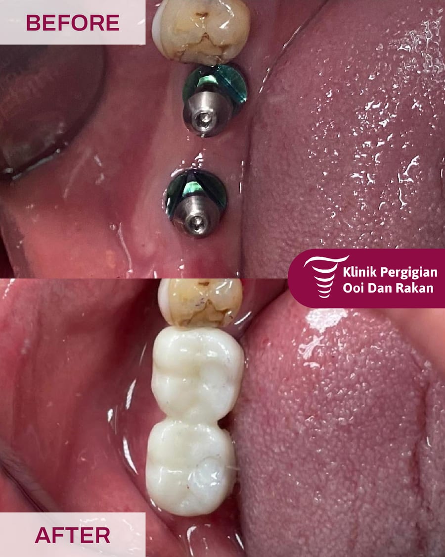 Before and after dental implant treatment at Ooi Dan Rakan, case 3