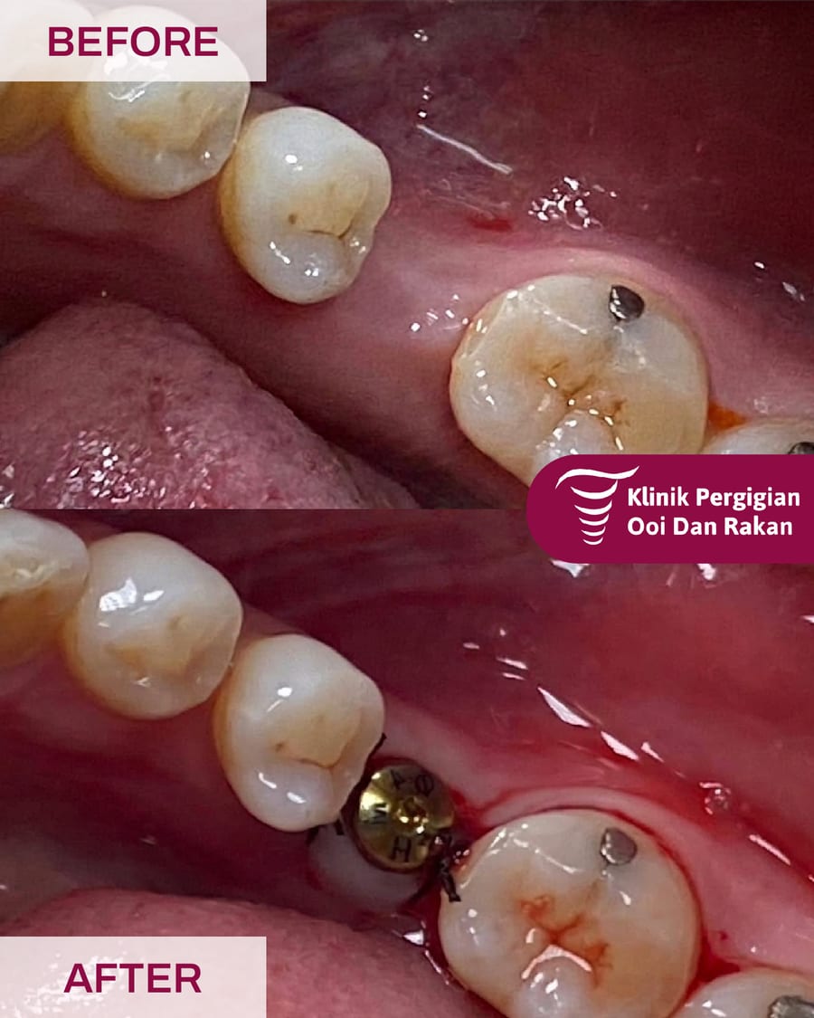 Before and after dental implant treatment at Ooi Dan Rakan, case 4