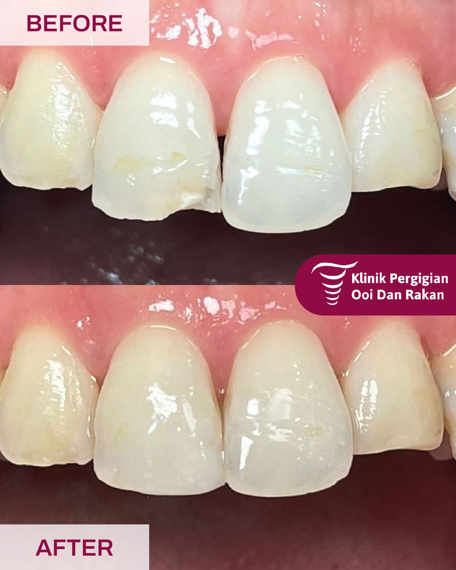 Before and after filling treatment at Ooi Dan Rakan, case 1