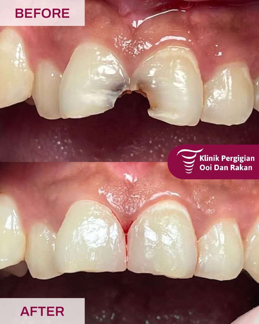 Before and after filling treatment at Ooi Dan Rakan, case 2