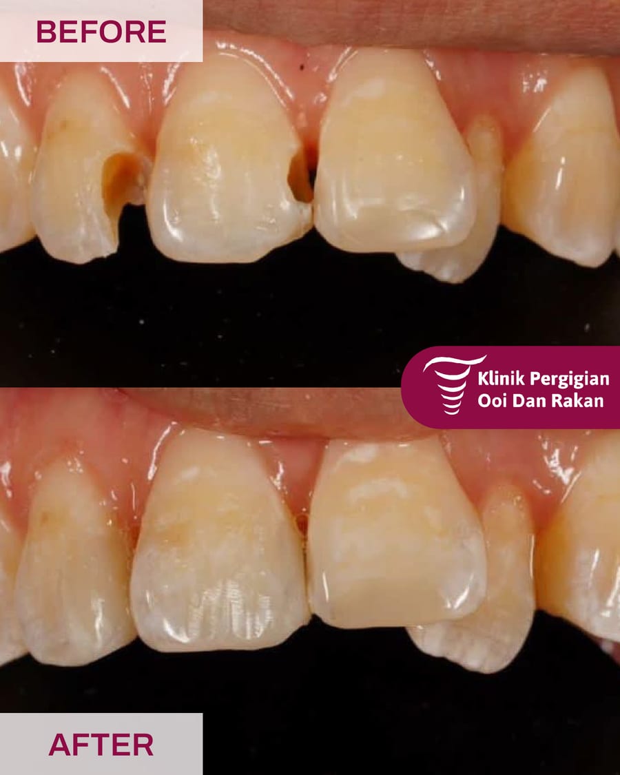 Before and after filling treatment at Ooi Dan Rakan, case 3