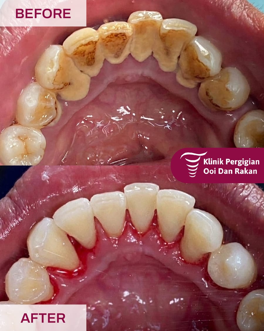 Before and after scaling and polishing at Ooi Dan Rakan