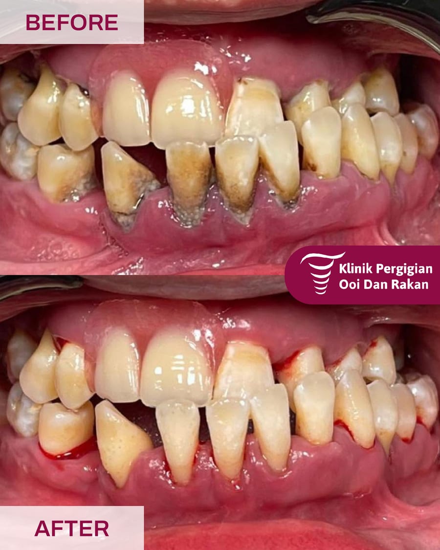 Before and after scaling and polishing at Ooi Dan Rakan, case 2
