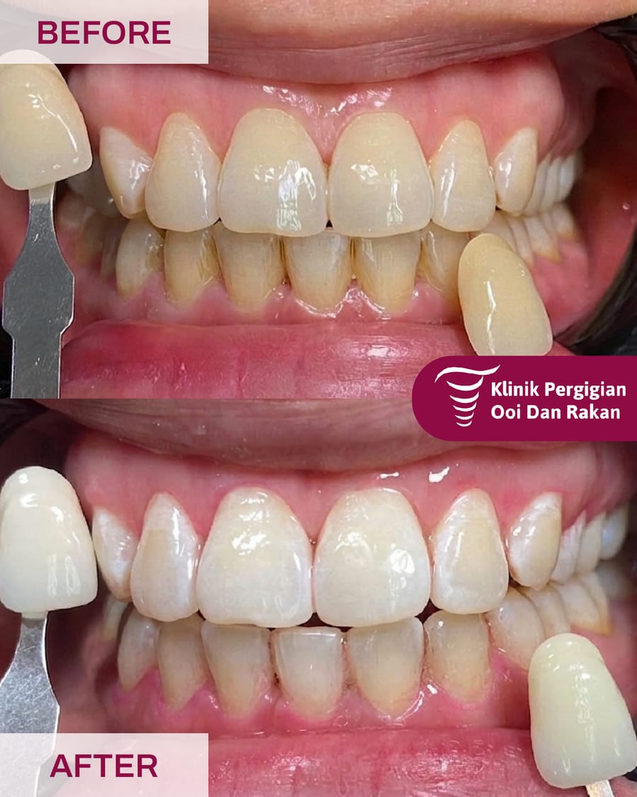Before and after scaling and polishing at Ooi Dan Rakan, case 5