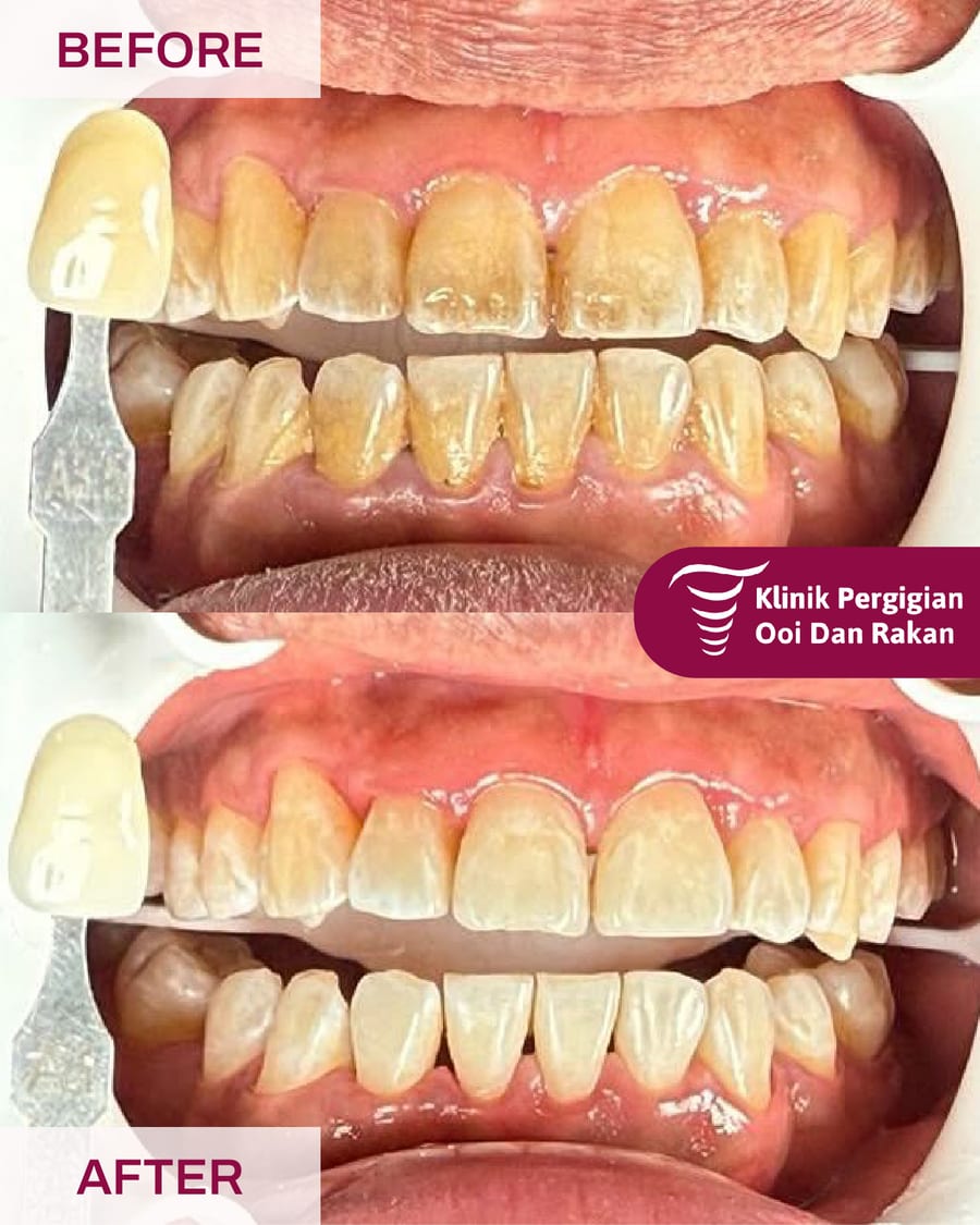 Before and after teeth whitening at Ooi Dan Rakan, case 2