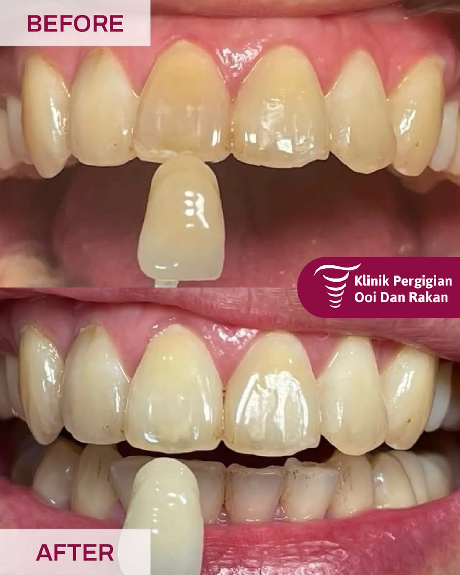 Before and after teeth whitening at Ooi Dan Rakan, case 3