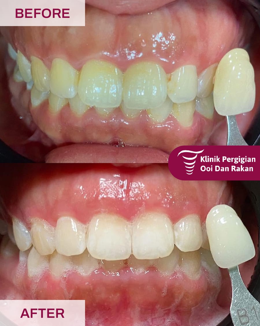 Before and after teeth whitening at Ooi Dan Rakan, case 4