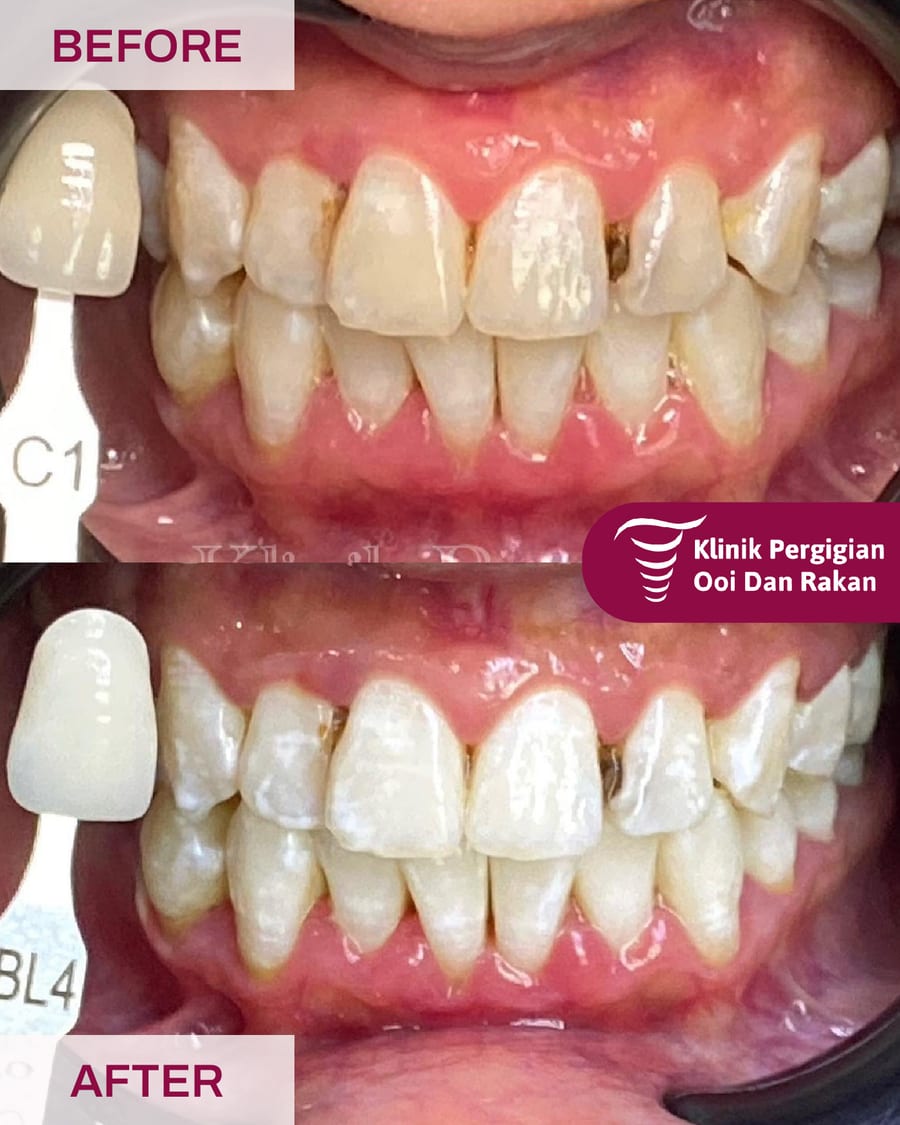 Before and after teeth whitening at Ooi Dan Rakan, case 5