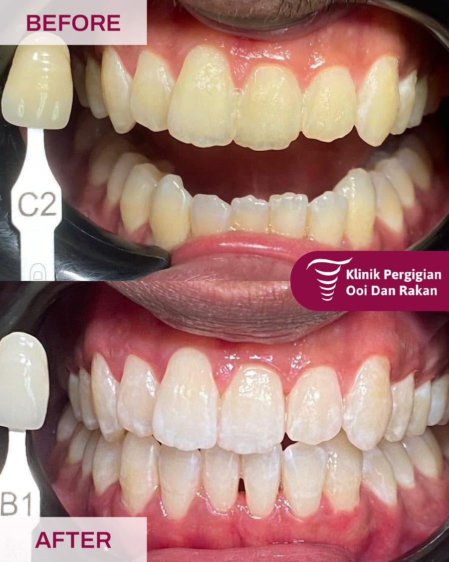 Before and after teeth whitening at Ooi Dan Rakan