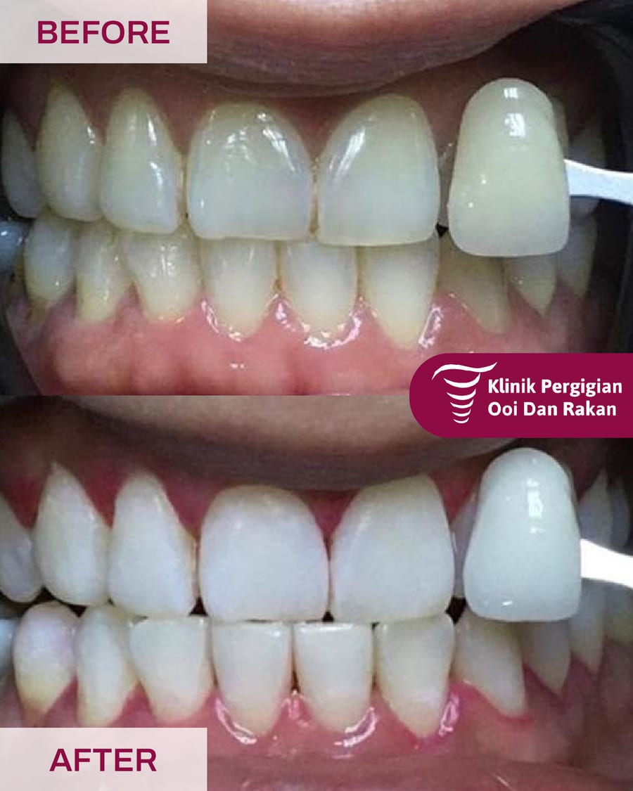 Before and after teeth whitening at Ooi Dan Rakan, case 7