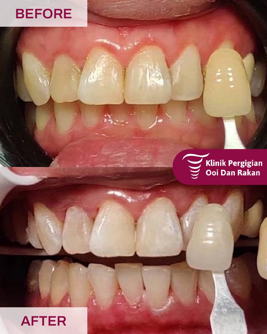 Before and after teeth whitening at Ooi Dan Rakan, case 8