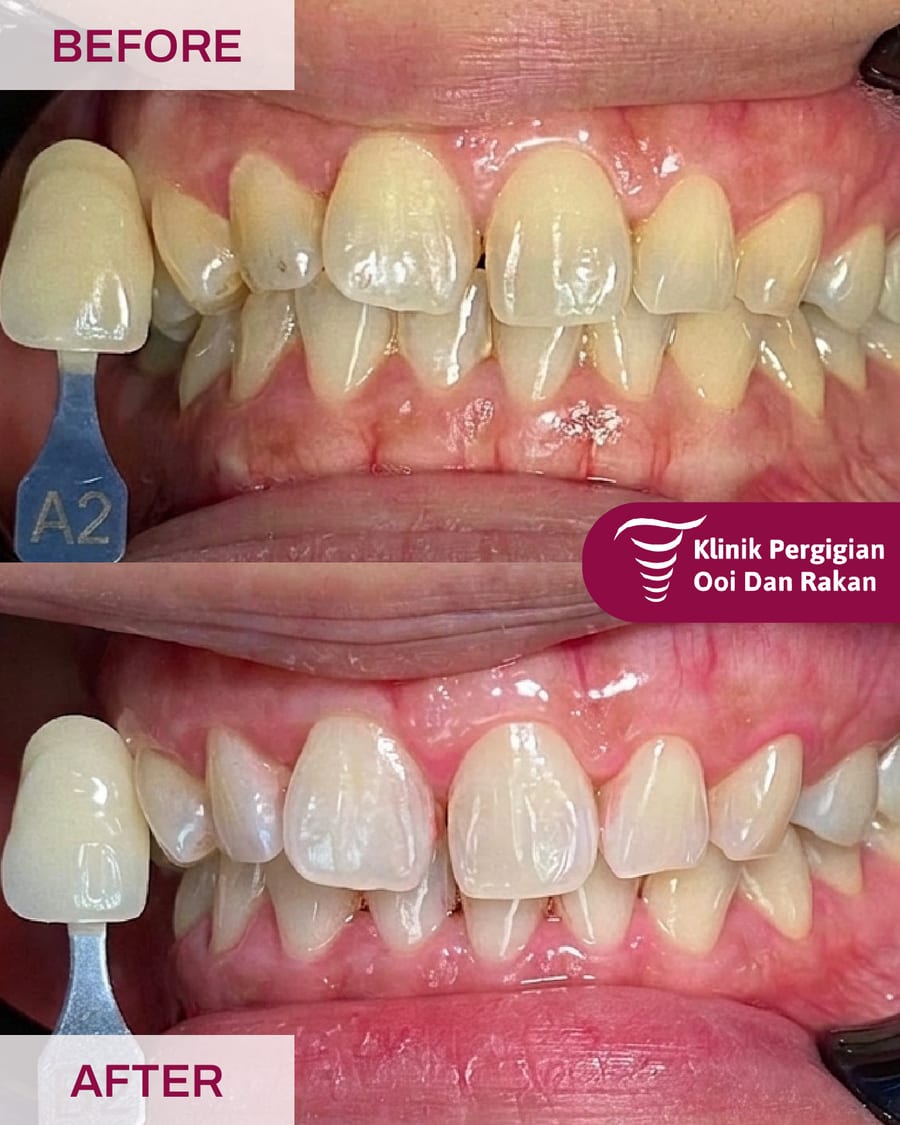 Before and after teeth whitening at Ooi Dan Rakan