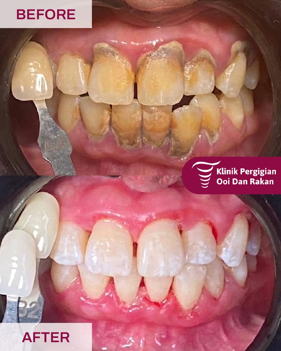 Before and after teeth whitening at Ooi Dan Rakan, case 10