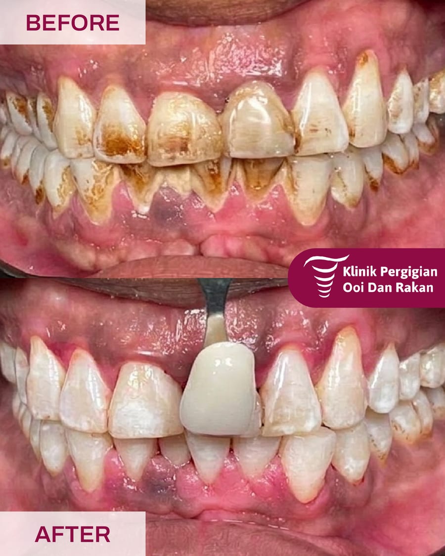 Before and after teeth whitening at Ooi Dan Rakan, case 11