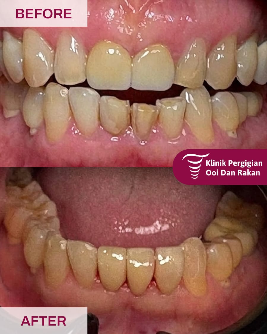 Before and after veneers at Ooi Dan Rakan, case 1