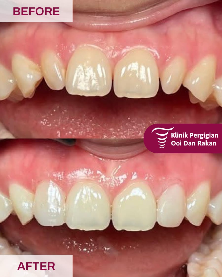 Before and after veneers at Ooi Dan Rakan