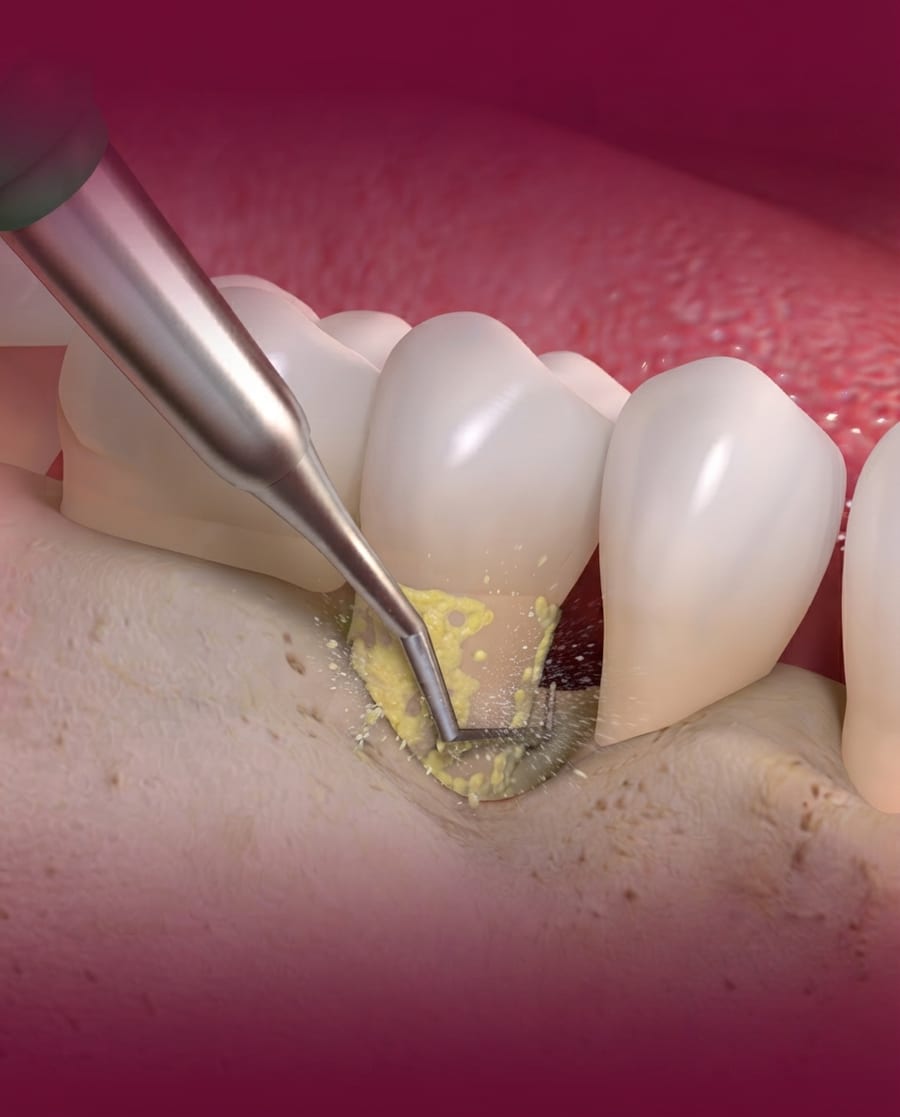 Deep cleaning treatment being performed at Ooi Dan Rakan