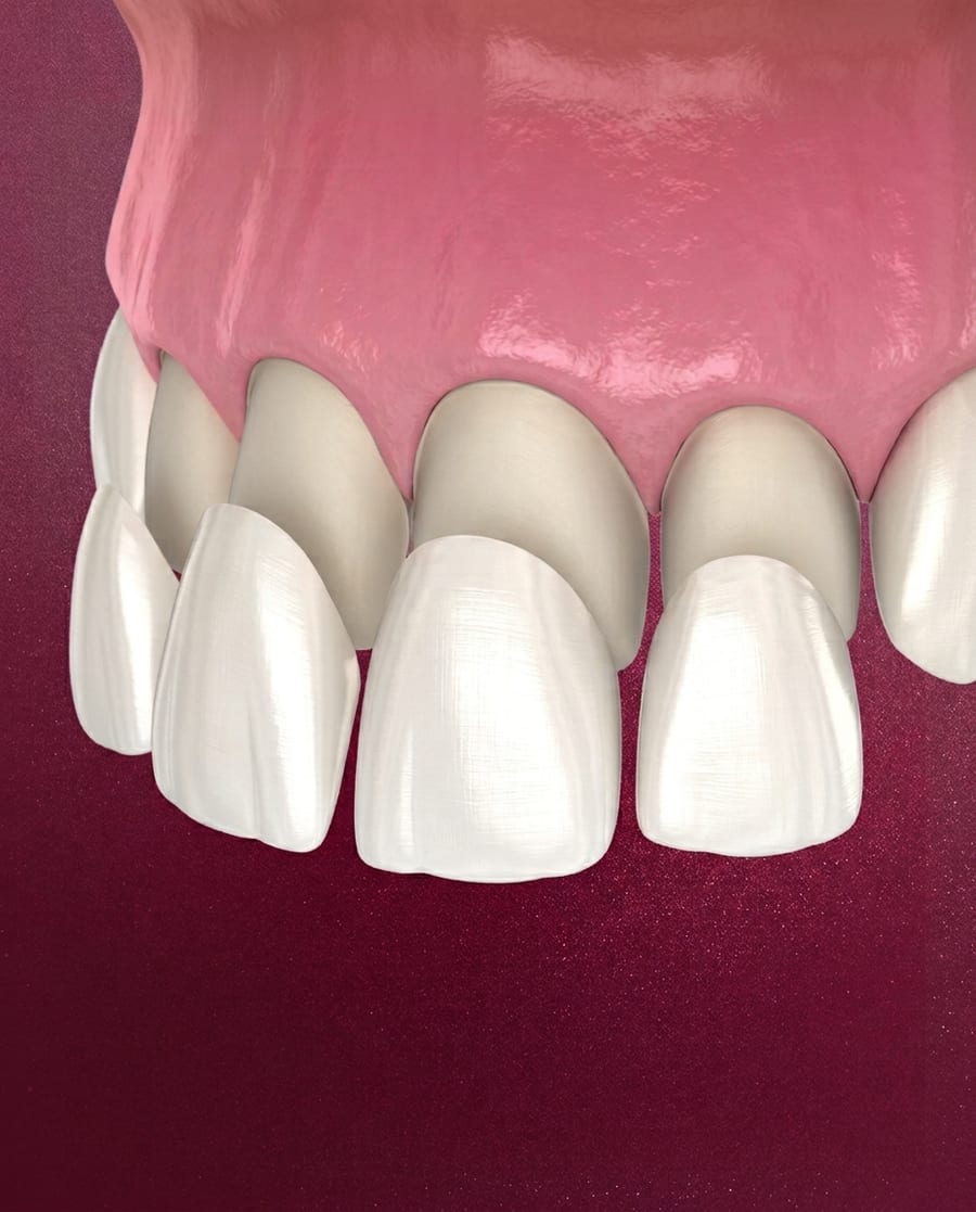 Custom veneers shown at Ooi Dan Rakan